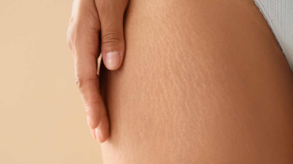 Stretch Marks On Skin Awaiting Natural Care