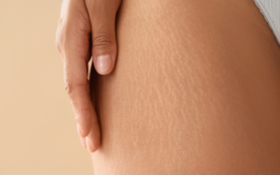 Essential Oils For Stretch Marks: Fade Lines And Support Skin Renewal 